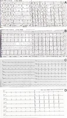 Giant Paraganglioma Complicated With Catecholamine Crisis and Catecholamine Cardiomyopathy: A Case Report and Review of the Literature